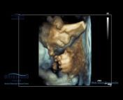 Ultrasound Ireland: Medical, Pregnancy Scans u0026 IVF Fertility Scans