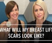 It&#39;s a common concern, so let&#39;s talk about what to expect for scarring after a breast lift!nnIn this educational (AND fun!) Amelia Academy video, Jenny and Gretta walk you through what to expect for scars after a breast lift and what you can do to minimize their appearance and have the best results!nnReady to get started? Let&#39;s go!nnSign-Up for Amelia Academyn******************************nhttps://tv.askamelia.comnnLearn More About Amelia Aestheticsn**************************************nhttps:/