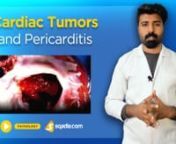 Cardiac Tumors and Pericarditis are the key focus of this online medical pathology lecture. A range of such tumors are discussed in this V-Learning™ for an easy understanding of the medical students. These include Myxomas, Papillary Fibroelastoma and Rhabdomyomas. You can also gain full knowledge on the Pericarditis alongside Metabolic Diseases of the Heart in this medical lecture.nn-------------------------------------------------------------nWatch complete lecture on sqadia.com:nhttps://www.