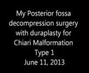 This is a video record of my daughter&#39;s Posterior fossa decompression surgery with duraplastyfor Chiari Malformation Type 1. She had 28 stitches on the outside of her skull and not sure how many she had inside.nnHer herniation was 12 mm. She had a Syringomyelia (Syrinx) at the C3 level and blockage of the Cerebral Spinal Fluid. At this point we have not had a repeat MRI so the status of her Syrinx is unknown. She was diagnosed on April 16, 2013 and had surgery on June 11, 2013.nnShe had many s