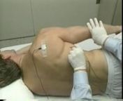 Which actions of the arm muscle are being studied by needle electromyography?nnAdduction, external rotation, and flexion of the arm.tnAbduction, internal rotation, and extension of the arm.tnAdduction, internal rotation, and extension of the arm.tnAbduction, internal rotation, and flexion of the arm.tnAdduction external rotation, and scapular depression.nnIf choice c is selected, set score to 1.nnSUMMARY:nThe muscle is the latissimus dorsi. It is a major adductor, internal rotator (medial), and