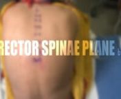 Erector Spinae Plane BlocknnA novel inter-fascial plane block first described in 2016. This technique has been used for analgesia for the following procedures:n- Video-assisted thoracoscopic surgery (VATS)n- Pulmonary lobectomyn- Thoracic rib and sternal fracturesn- Mastectomyn- Axillary sentinel lymph node biopsyn- Abdominal surgeryn- Hip surgeryn- Thoracic neuropathic pain reliefnnUnique Contraindications:n- Localized active infectious process at injection siten- Extensive tissue depth between