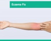 Get this course at https://yvar.com/course/eczema-fix/, 90% discount with coupon code ‘e9q’.nnEczema is an auto-immune disease where the body refuses to function as it should.nnAlthough the eczema rash has been around for thousands of years, we still know far too little about it. Research is just beginning. It has shown that changes in lifestyle habits can have a tremendously beneficial effect of eczema.nnThis video course will discuss exactly what eczema is and how it can be treated to redu