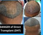 It has come to our notice that many patients have undergone substandard procedures in name of hair transplant.nIn addition, their doctor or clinic told them that only 50 to 60% of the transplanted hair are expected to grow (something that is totally misleading and a lie). nSuch procedures are sold with a the USP of Direct hair transplant (DHT) viz., that the grafts are extracted and then inserted into the recipient slits without examination under microscope and dissection of unnecessary skin (de