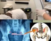 What is Sacroiliac Joint Pain and Block?nTHE SACRO-ILIAC JOINT is a large joint that connects the spine to the pelvis. When the joint develops sacro-iliac joint disease, it can cause pain in its immediate region or it can refer pain into the groin, abdomen, hip, buttock or leg. The sacro-iliac joint block is quick, non-invasive, and uses Fluoroscopy Guided-Image Technology to ensure that medication is applied at a high degree of accuracy. A sacro-iliac joint block’s purpose is twofold: to diag