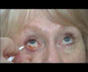 Fluorescein staining of the cornea is performed by first placing a drop of sterile saline on a sterile fluorescein strip.The fluorescein is then placed in the inferior cul de sac of the eye by pulling down on the lower lid and gently touching the bulbar conjunctiva with the fluorescein strip.The patient blinks to distribute the dye, and the cobalt blue light is used to determine if there are any corneal epithelial defects.