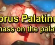 http://www.NoseSinus.comnnTo learn more about torus palatinus surgery, watch this video:nhttp://www.youtube.com/watch?v=2M830u...nnDr Kevin Soh describes how a torus palatinus is removed using videos from live surgery and graphics.nn3 Mount Elizabeth, #07-02, Mount Elizabeth Medical Centre, Singapore 228510nnhttps://www.google.com.sg/maps/place/...nnIf you have any comments, PLEASE do not be afraid to ask. Please SUBSCRIBE, SHARE, and COMMENT on this video.nnIf you prefer to read, rather than wa
