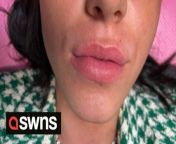 A teenager who got addicted to lip fillers aged 16 after having them injected in her living room says the procedure should be more tightly regulated.&#60;br/&#62;&#60;br/&#62;Maisie-Jane Southwell, now 19, lost confidence in her looks and turned to fillers after seeing others around her with them and liking their appearance. &#60;br/&#62;&#60;br/&#62;She paid £100 to have it injected in her mum&#39;s living room - and soon became obsessed with her looks.&#60;br/&#62;&#60;br/&#62;Despite some experts advising 0.5 or 1ml of filler she had 4ml injected in just nine months, and says her lips &#92;